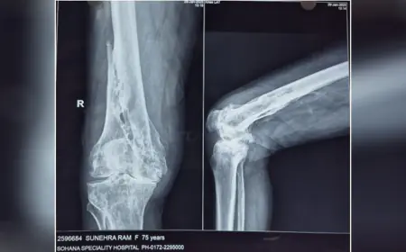 Dr. Gagandeep Sachdeva and Team Successfully Perform Robotic Knee Replacement Surgery